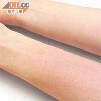消委會指使用微針後，皮膚可能出現明顯泛紅、腫脹及有血絲滲出。