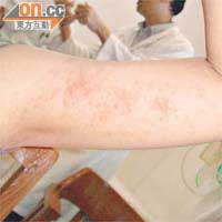 女童手臂出現類似濕疹物體，化驗證實是鈣化物質。	（韓錦倫提供）