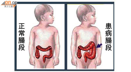 先天性巨結腸症嬰兒因腸道缺乏神經細胞，無法控制排便，糞便在結腸滯留。