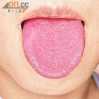 草莓舌是猩紅熱的常見徵狀。