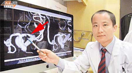 梁慧康利用三維數碼減影血管造影技術，電腦左圖顯示中風患者的動脈一處豆狀凸起物（箭嘴示），梁解釋是「潰瘍性斑塊」斷裂徵狀。