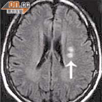 顱內動脈硬化是導致亞洲人中風的主因，圖中所示為一名因左腦血管閉塞引致右半身癱瘓病人的腦掃描影像。