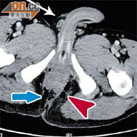 電腦掃描顯示五旬男病人肛門軟組織及坐骨直腸窩（藍箭嘴及紅箭頭）有氣腫，陰囊（白箭嘴）則不受影響。	（《香港急症醫學期刊》圖片）