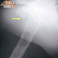 Ｘ光掃描圖片可見，溶骨性病變會導致肩膊移位的骨折。