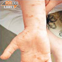 一歲多女童手腳及軀幹滿布紅疹，證實為罕見的呼吸道合胞體病毒徵狀。（受訪者提供）