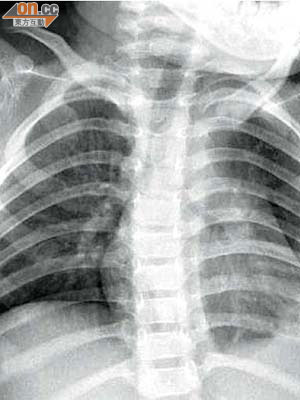 感染肺炎球菌的一歲半男童左肺嚴重積水，X光片顯示左肺呈白色，氣管則被擠壓至略為傾向右肺。	（受訪者提供）