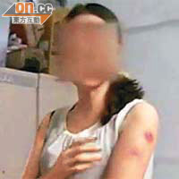 深圳有女士於美容院接受羊腸線減肥後，手臂及腹部留下十八個瘡洞。（電視畫面）
