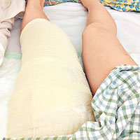 由於腫瘤較大，Constance的左腿在手術後留有三十厘米長的疤痕。