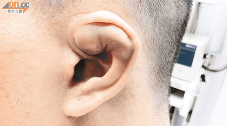 耳廓血腫患者術前的耳廓呈有瘀血色腫塊。