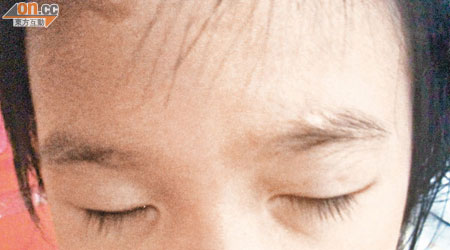 吳小英的長女因抓破了水痘，弄至臉上及眉頭留有疤痕。（受訪者提供圖片）