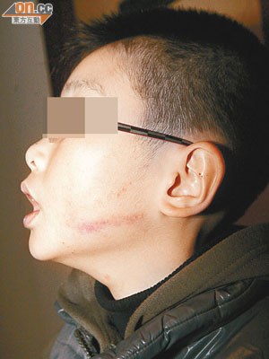 男童的左臉於上堂後發現有被打傷紅痕。