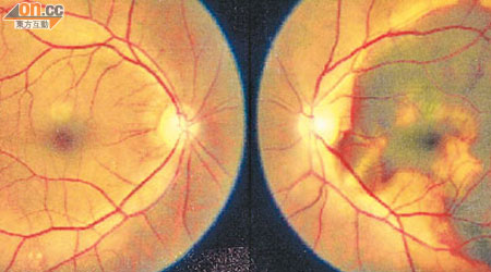 濕性老年黃斑病變由眼內血管增生所致，長遠可以致盲。