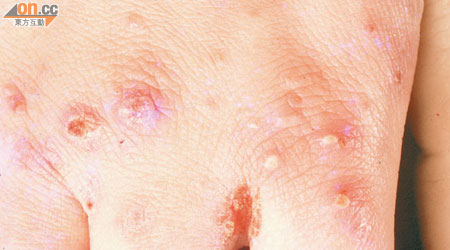 疥瘡主要生在手指縫位置，紅腫斑點令人痕癢難耐。