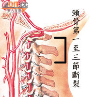 阿堂傷勢示意圖