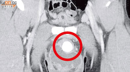三十九歲男子因陰囊腫痛及小便困難求診，電腦掃描發現近陰莖的尿道內有一粒直徑四厘米的巨型結石（紅圈示）。（《香港醫學雜誌》圖片）