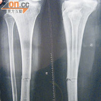 鍾欽祥雙腿遭打斷，右小腿兩處骨折。
