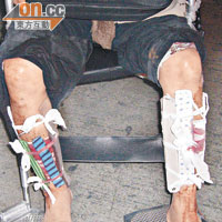 鍾欽祥雙腿被打斷後，經包紮仍不斷流血。
