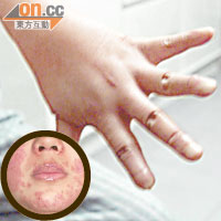 紅斑狼瘡患者的手腳（右圖）或臉部（左圖）位置也有機會出現紅腫。（資料圖片）