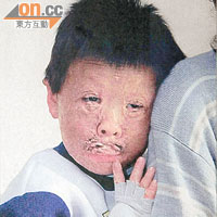 九五年《東快訊》刊登一名燒傷男童的求助報道，男童相片最初被判為第二類物品。