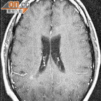 65歲婆婆磁力共振影像顯示，患病後腦室（中央黑色部分）較正常倍增，顯示腦積水嚴重。