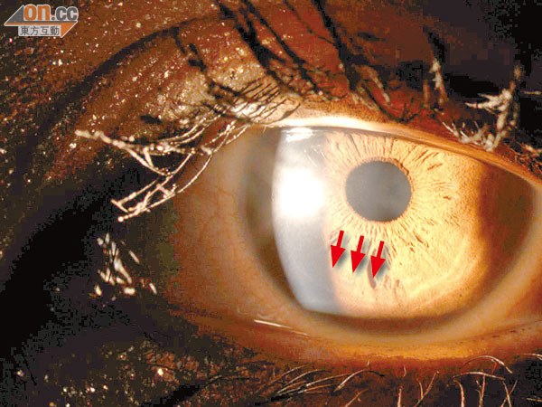 LASIK 鐳射手術 0429-00176-096b3