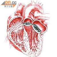大動脈人工心瓣