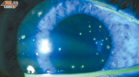 患者的角膜及結膜位置都布滿白點。