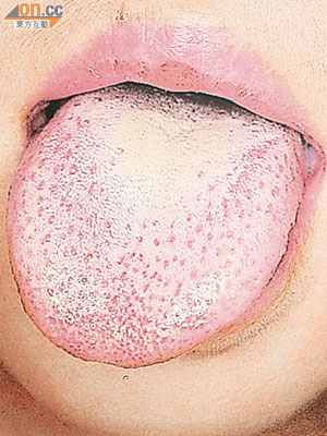 猩紅熱患者出現草莓舌等典型病徵。（資料圖片）