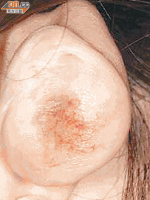 有女士在耳骨釘環後長出肉芽。（受訪者提供）