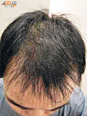 禿頭可能是前列腺癌的警號。