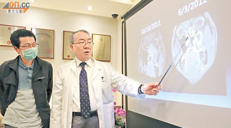 張文龍（右）指經過局部及鞏固治療後，鄧先生的鼻腔腫瘤已縮小。