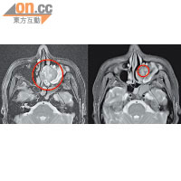 鄧先生化療後，左邊鼻咽腫瘤仍有4.5-6厘米大，經治療腫瘤消失（圖右）。