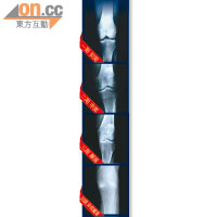 膝關節炎初期輕微腫痛，情況嚴重時，可見骨頭間空隙逐漸縮窄。