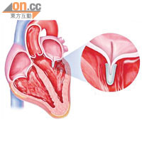 微細的MitraClip將二尖瓣倒流患處緊閉。