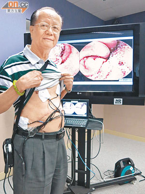 李先生於吞食膠囊前須先於腹部貼上並接通檢測器，以便接收由膠囊拍攝的大腸內壁影像。