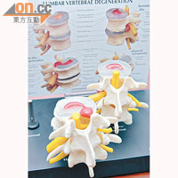脊椎退化，可致椎間盤突出及椎管狹窄等引發痛楚。