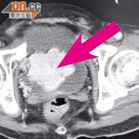 電腦掃描圖片顯示，病人膀胱底部位置長了一個大腫瘤（箭嘴示）。