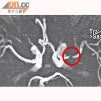 磁力共振圖片可看見，缺向性中風患者的血管受阻塞（紅圈示），導致腦功能障礙。