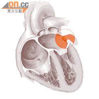 左心耳是左心房的末端，其網狀心臟肌肉組織容易令血液凝固成血塊。
