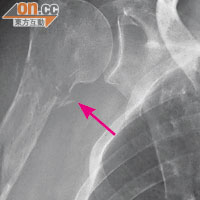 骨髓瘤可溶化骨頭，圖中患者的右肩骨已遭癌細胞侵蝕至骨折（箭嘴示）。（受訪者提供）