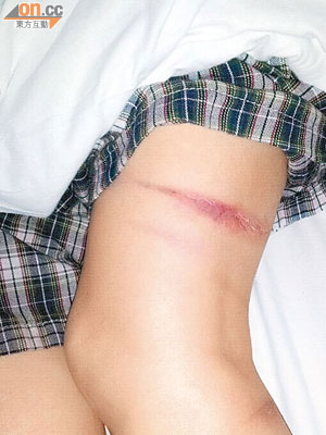 左大腿亦被天花不銹鋼割傷。