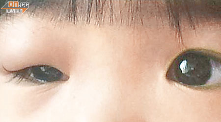女童的右眼紅腫，幾乎張不開眼睛。