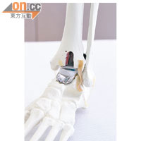 新一代足踝人工關節的聚乙稀，可取代關節軟組織，令關節活動更靈活。