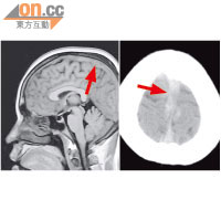 左圖：病人腦靜脈竇栓塞（箭嘴），右圖：腦部中上方靜脈密度偏高（箭嘴）。（《香港急症醫學期刊》提供）
