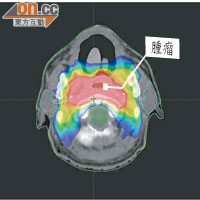 鼻咽癌腫瘤深藏於頭顱中央，電療時需小心避開重要器官。