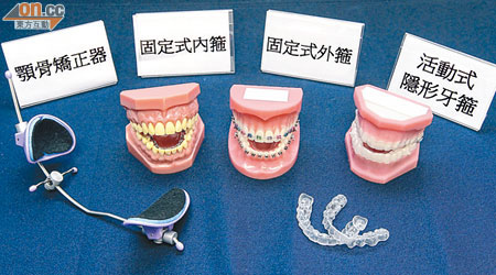 近年矯齒技術已有多種選擇，除了傳統的固定式金屬牙箍，亦有活動式隱形牙箍，每日佩戴廿二小時，有需要時可脫下，適合愛美人士。（何天成攝）