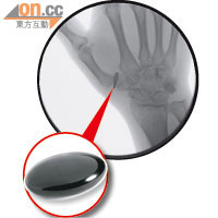 患拇指關節炎的空姐於右手植入熱解碳（紅圈示），順利康復。