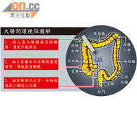 大腸閉環梗阻圖解