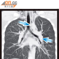 電腦掃描顯示青年的縱隔腔出現大範圍氣腫（白色部分）。（箭嘴示）