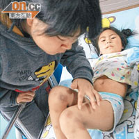 受害學童的雙腿或全身出現血瘀斑點的中毒徵狀。